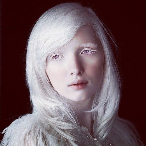 I Am In Love With An Albino Girl