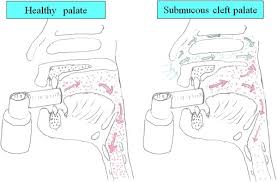 Split Uvula - Wrought Speech Defect